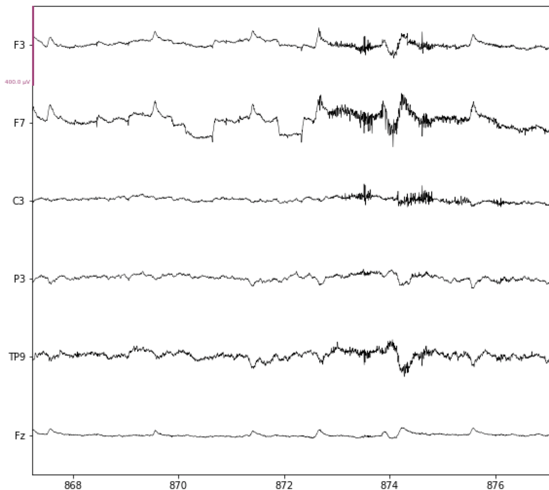 Artifacts in EEG Data — Neural Data Science in Python