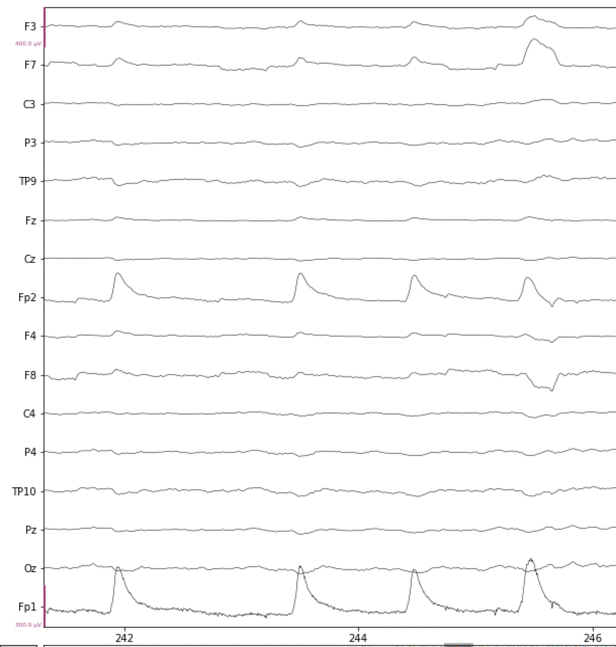 Artifacts In Eeg Data — Neural Data Science In Python