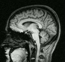 A sagittal slice through the brain of a human, through the midline of the head. THe cerebral cortex and corpus callosum are visible, as are the ventricles and cerebrospinal fluid around the brain. The outer surface of the head is also shown, including the nose and mouth.