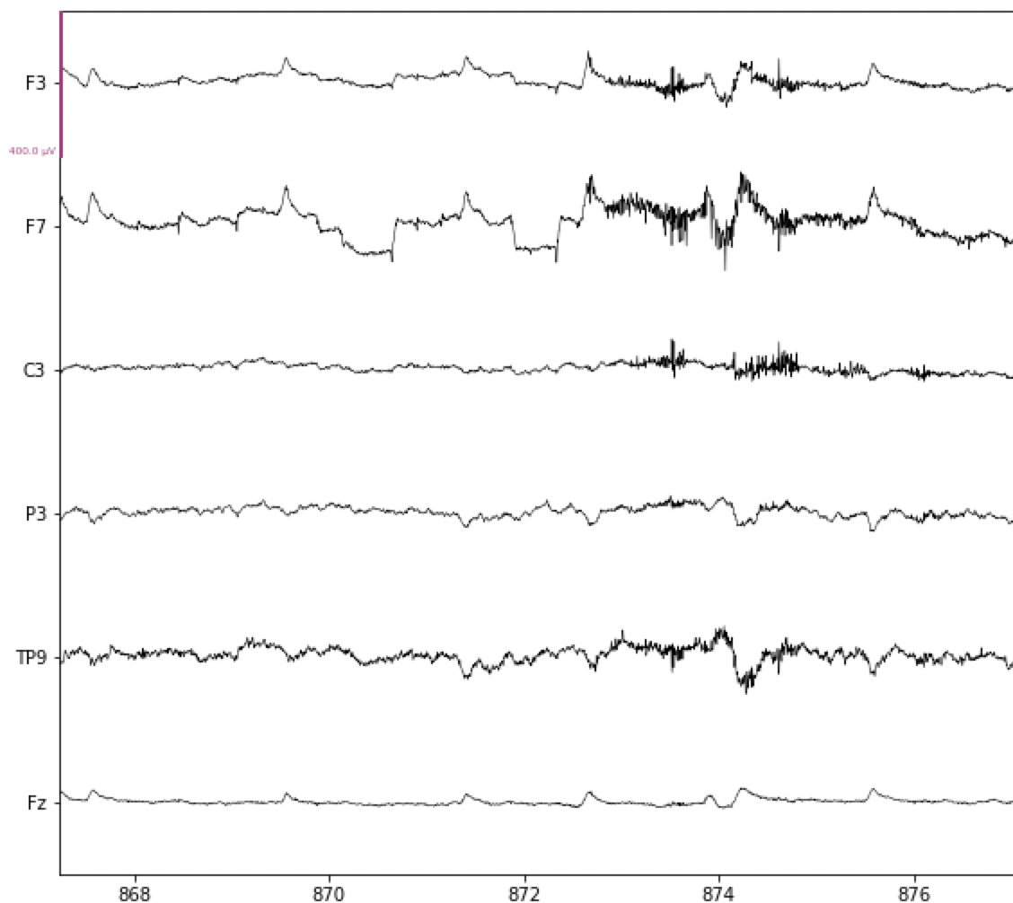 Example of muscle contraction artifact in EEG data.