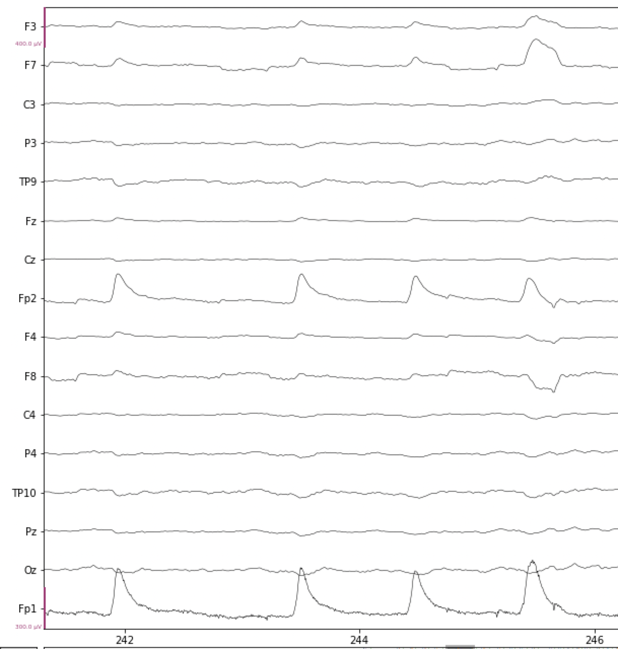 Examples of blink artifacts in EEG data.