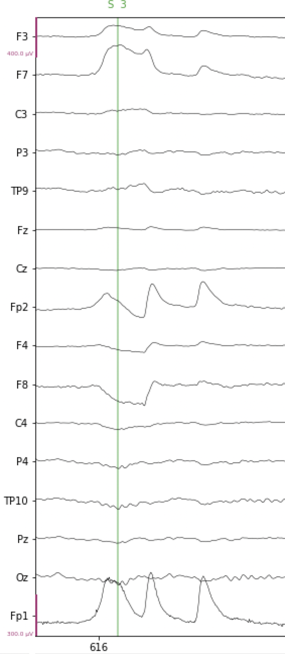 Example of horizontal eye movement artifact in EEG data.